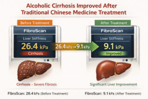 Fibroscan Result 9.1 KPa Reversal Of Cirrhosis With TCM